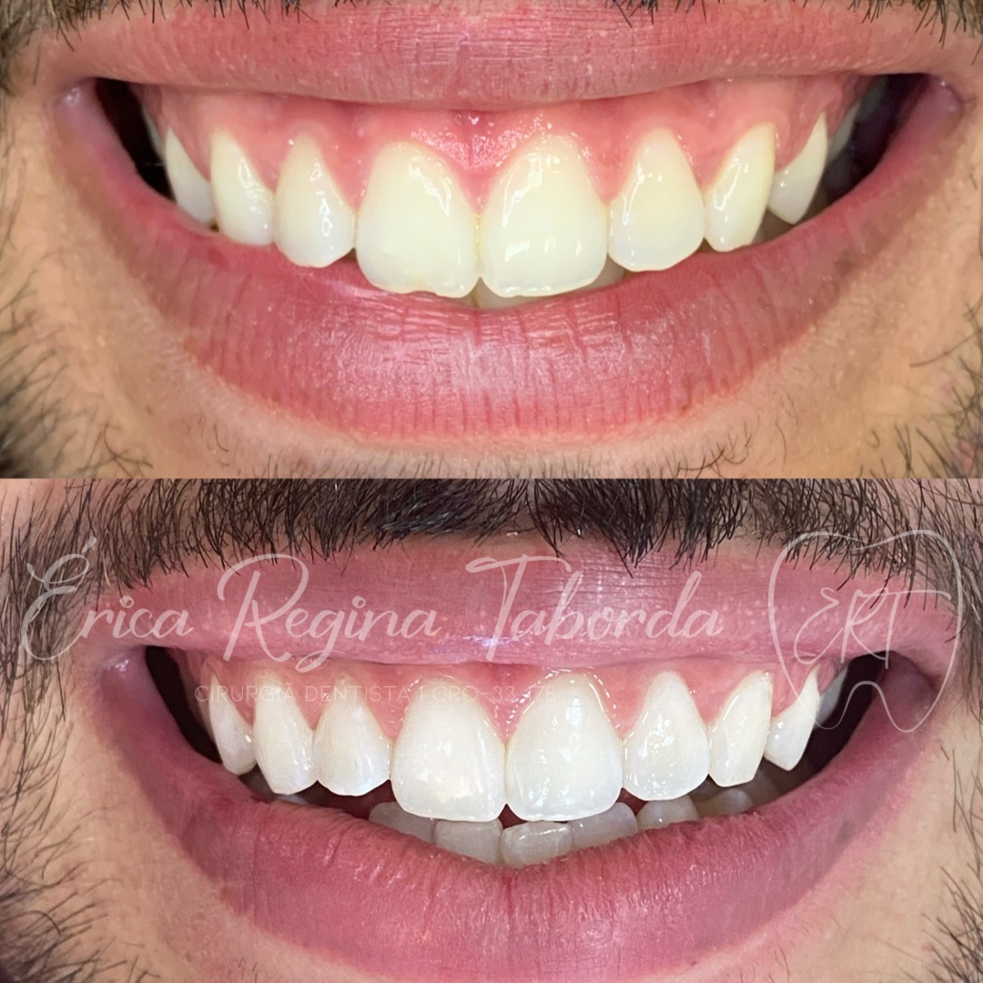 Estética dental completa