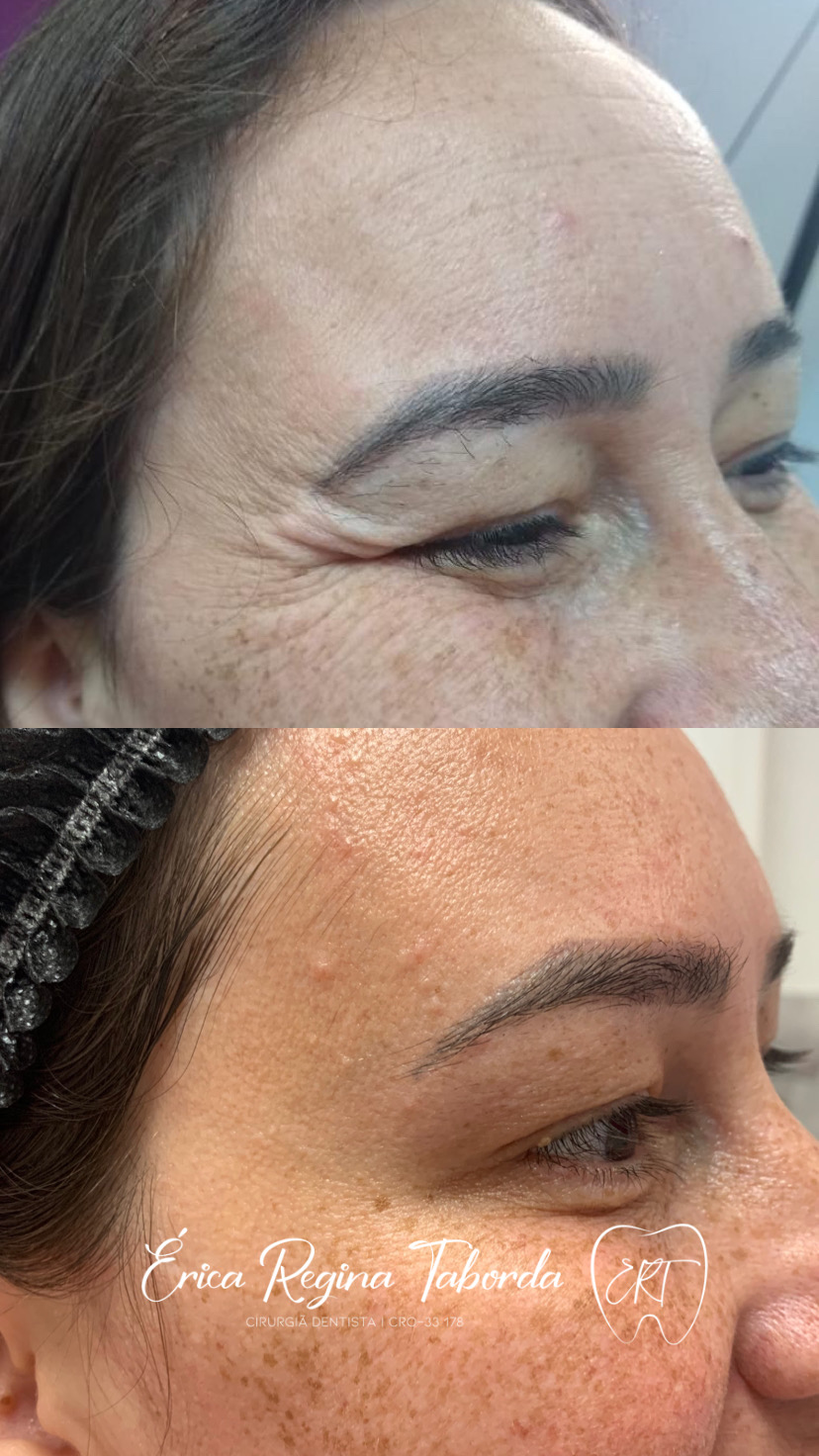 Rejuvenescimento do olhar