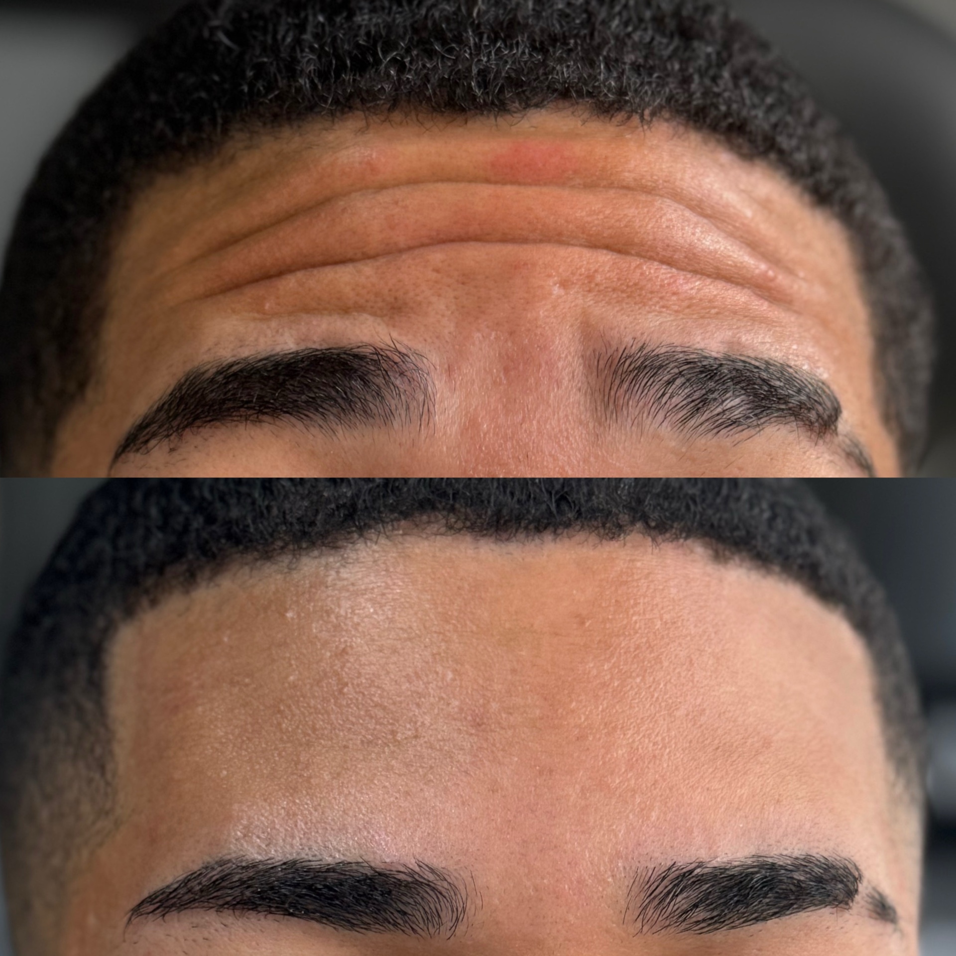 Botox para linhas da testa